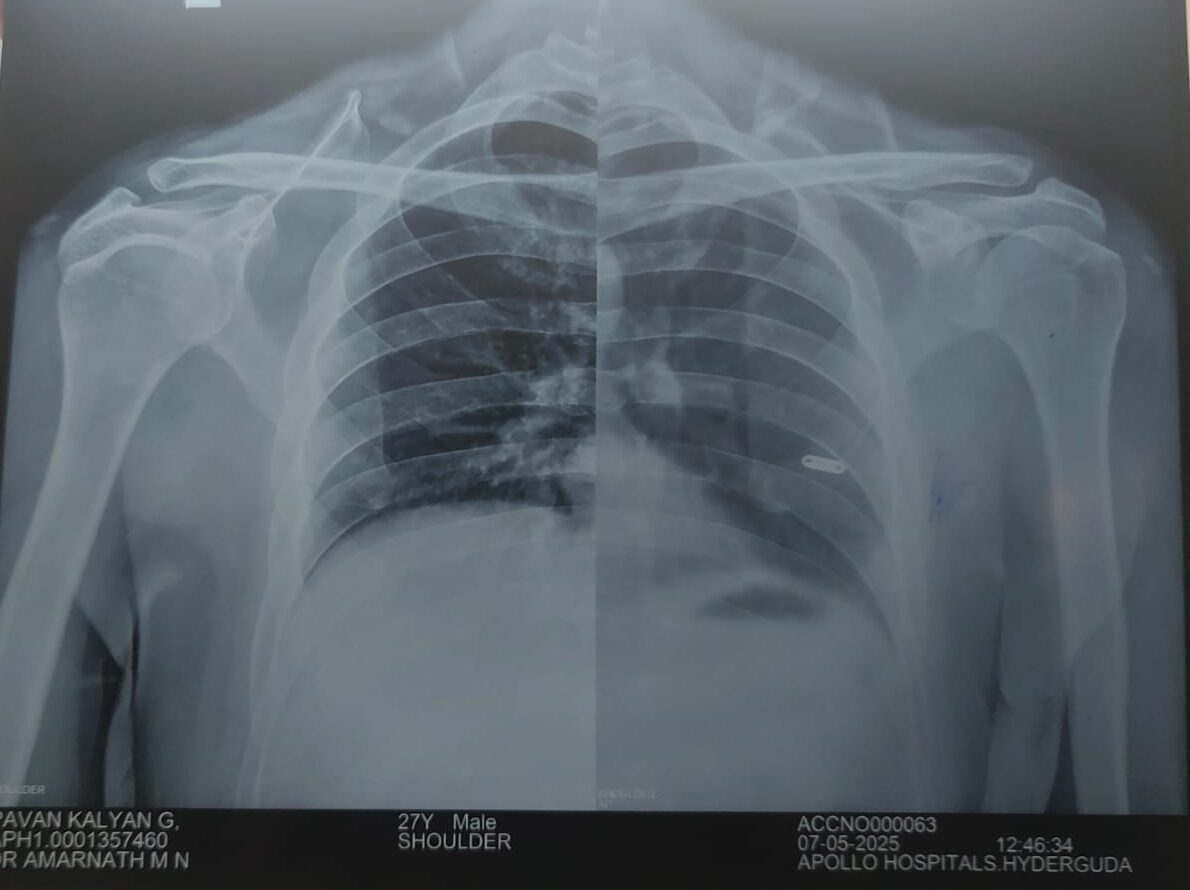 Shoulder Tendinosis Recovery