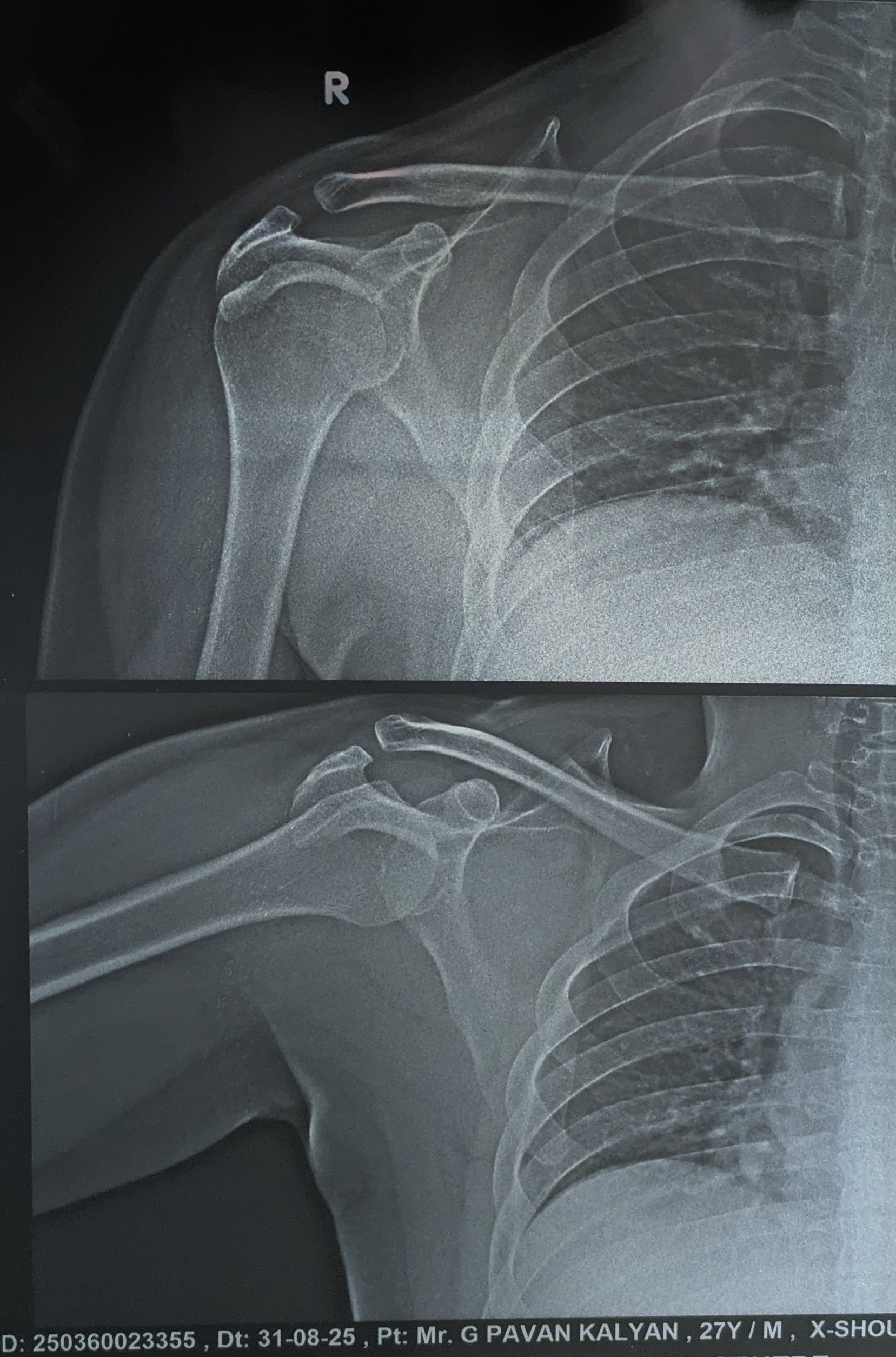 After 14 Days Treatment X-ray