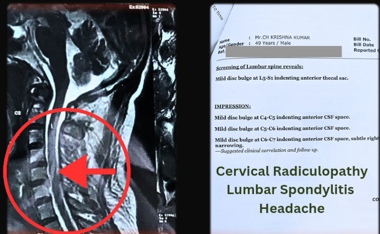 Cervical Radiculopathy Recovery