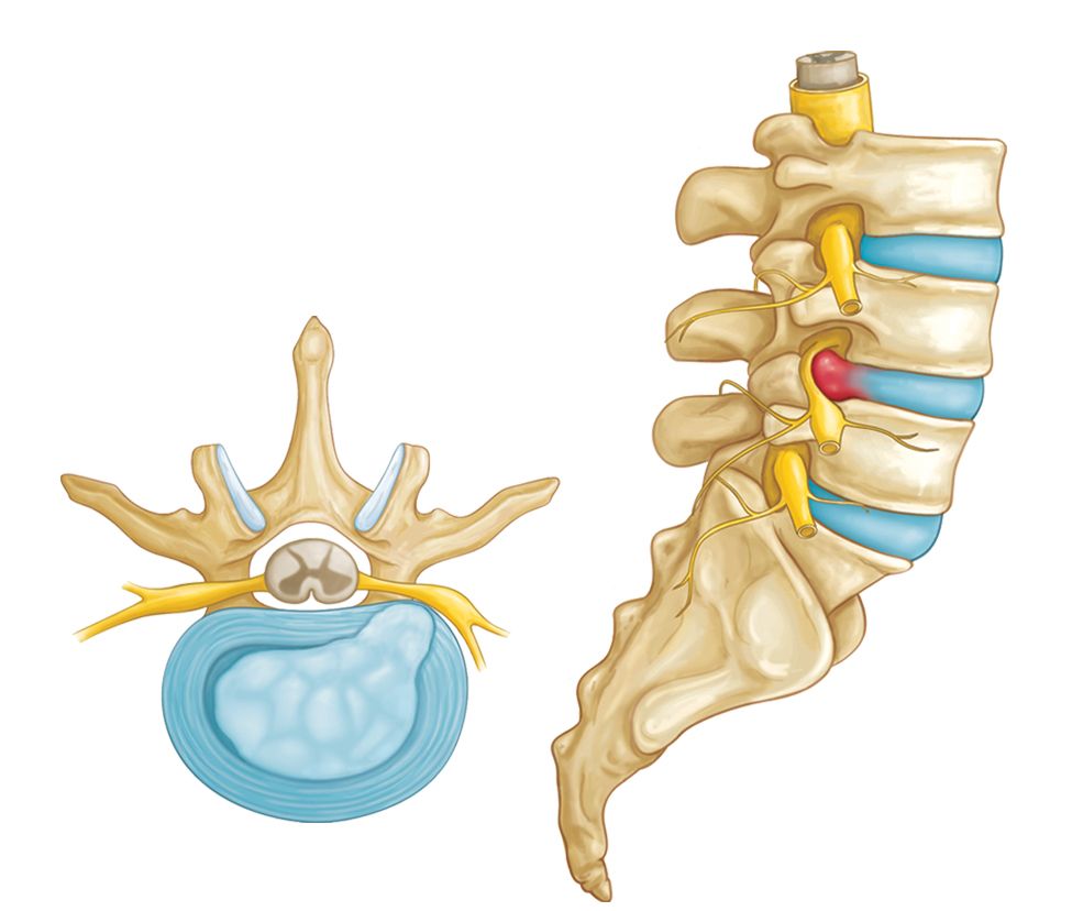 3 Anatomy chart showing the mechanical transition from a healthy spinal disc to a bulge and herniation