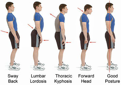 2 Graphic demonstrating how pelvic tilt and thoracic stiffness put an uneven mechanical load on lumbar discs