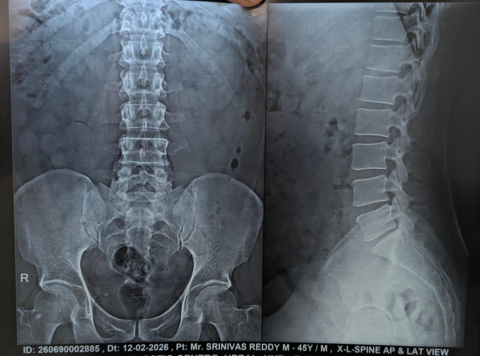 1 Mr. Srinivas Reddy - Lumbar Spine AP and Lateral View Radiograph