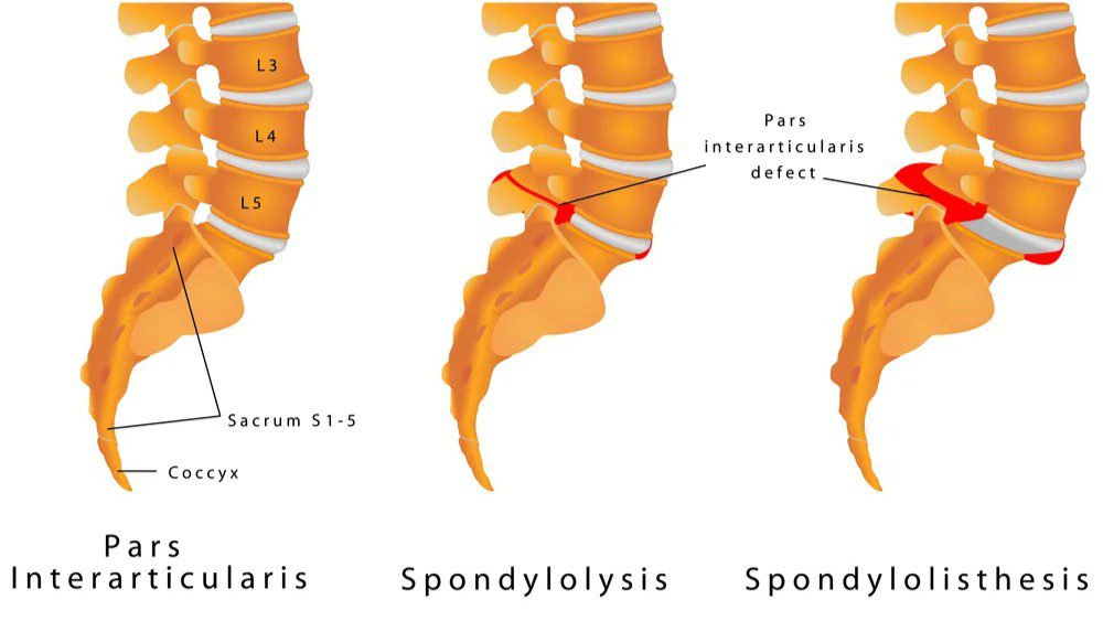 2 Clinical structural analysis mapping spinal alignment and structural disc changes